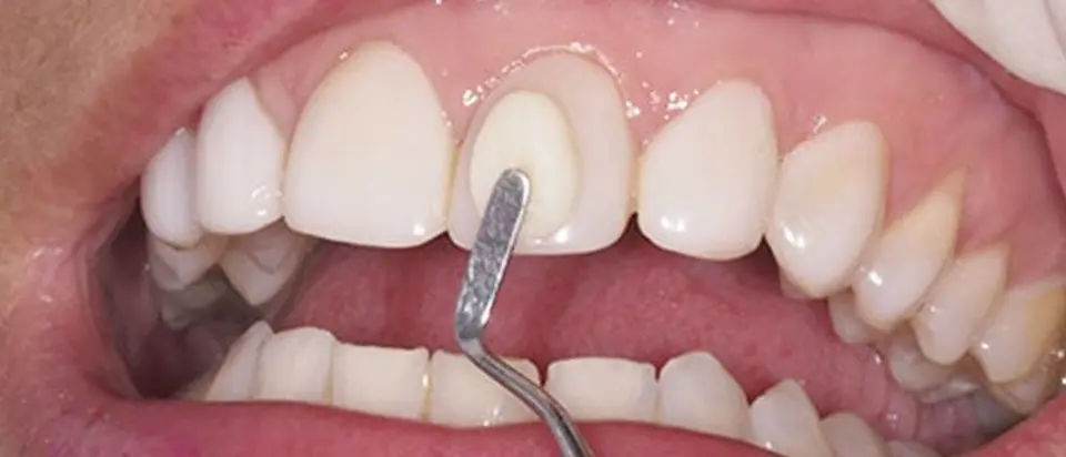 Cambio de Amalgamas por Resinas: Guía Completa para Pacientes - Cuándo se deben cambiar las resinas dentales cambio de amalgamas por resinas marketing odontologia - Cuándo se deben cambiar las resinas dentales