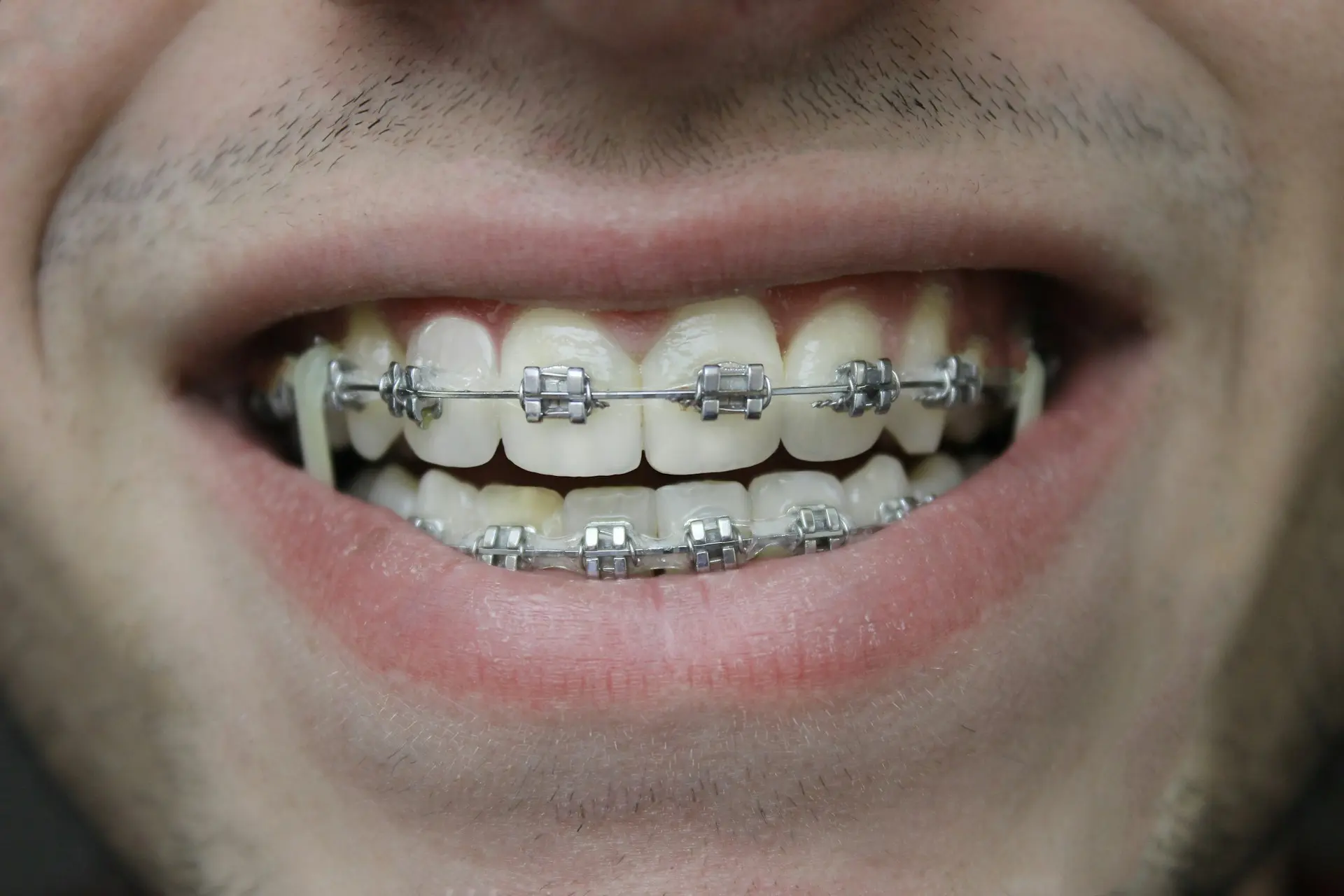 brackets publicidad - Cuánto cobran por poner brackets