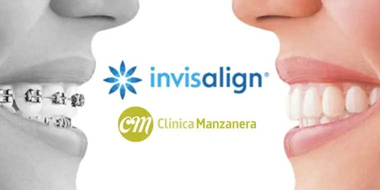 <b>Publicidad Invisalign</b>: Guía completa de costos, proceso y beneficios - Cuánto cuesta de media el Invisalign publicidad invisalign - Cuánto cuesta de media el Invisalign