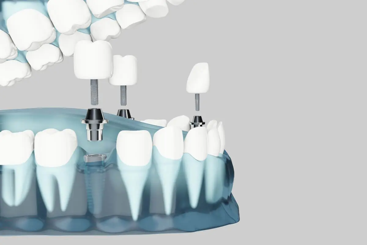 <b>Implante Dental</b>: Precio, Tipos y Todo lo que Necesitas Saber - Cuántos tipos de implantes hay anuncios de implantes - Cuántos tipos de implantes hay