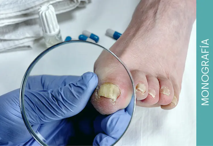 onicomicosis publicidad - Qué personas son más propensas a tener onicomicosis