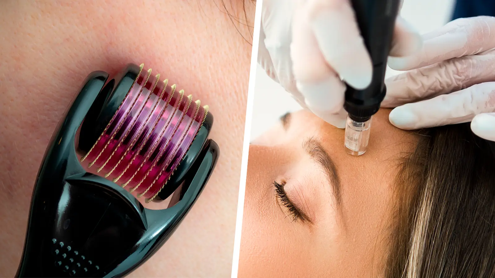 publicidad dermapen - Qué riesgos tiene el dermapen