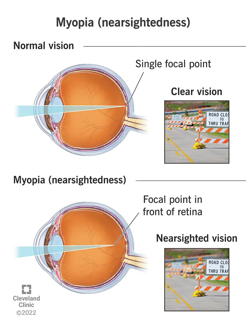 Marketing Myopia: Definición y Consecuencias para tu Negocio - What is the short definition of myopia marketing myopia definition - What is the short definition of myopia